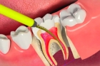 Лечение пульпита 2 канального зуба
