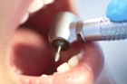 Лечение периодонтита зуба