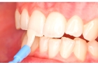Покрытие зубов фторсодержащими лаками