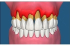 Лечение пародонтоза зубов