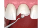 Эстетическое восстановление формы зуба