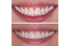 Восстановление цвета зуба