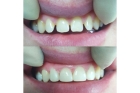 Частичная реставрация зуба
