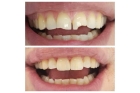 Реставрация скола зуба