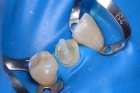 Эстетическая реставрация зуба со штифтом