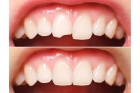 Реставрация передних зубов