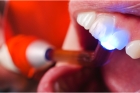 Пломбирование зуба светоотверждаемой пломбой