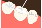 Пломбирование зуба композитной пломбой