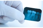 Рентгенография зубов