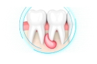 Цистотомия зуба