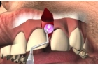 Резекция верхушки зуба