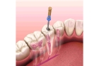 Резекция канала зуба