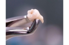 Удаление зуба простое