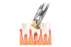 Удаление многокорневого зуба