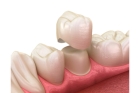 Коронка керамическая на зуб