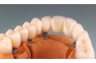 Протезирование зуба на импланте циркониевой коронкой