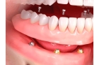 Несъемный протез при полном отсутствии зубов