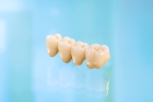Мостовидный зубной протез