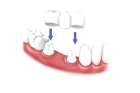 Зубной мост на 3 зуба