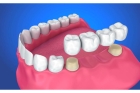 Зубной мост на 4 зуба