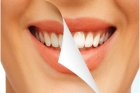 Косметическое отбеливание зубов
