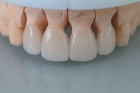 Керамические виниры для зубов