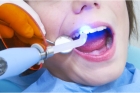 Пломбирование временных зубов