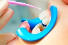 Фторирование зубов детям