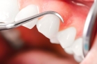 Лечение десен зубов 