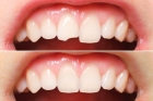Восстановление зуба  