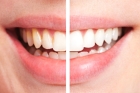 Восстановление цвета зуба 