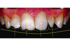 Восстановление дефектов зуба 