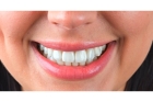 Восстановление передних зубов  