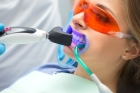 Пломбирование зуба светоотверждаемой пломбой 