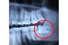 Рентгенография зубов  