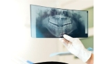 Рентгеновский снимок зуба    