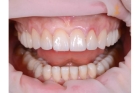 Коронка керамическая на зуб 