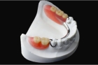 Съемное протезирование зубов 