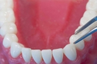 Протезирование нижних зубов 