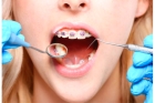 Установка брекетов на зубы 