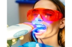 Профессиональное отбеливание зубов