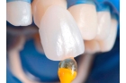Наращивание керамического зуба