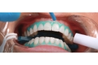 Отбеливание зубов двух челюстей