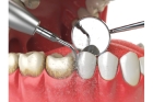Удаление зубных отложений 
