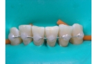 Металлическое шинирование зубов 