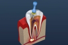 Лечение пульпита 4-х канального зуба