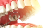 Лечение периодонтита 1 канального зуба