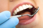 Лечение периодонтита 4-х канального зуба