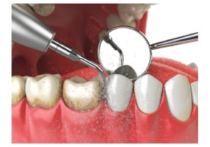 Удаление зубных отложений 