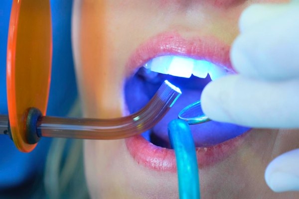 Пломбирование 1 канального зуба  